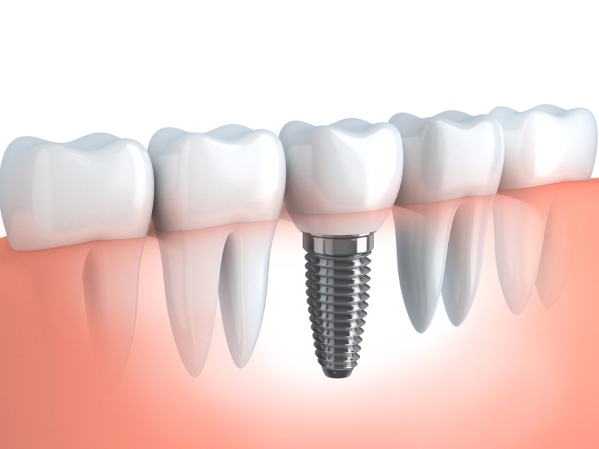 Dental Implant Cleaning Tools